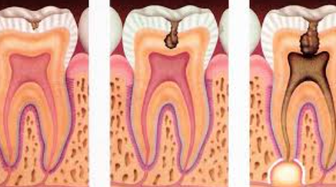 una caries entre dos dientes posteriores